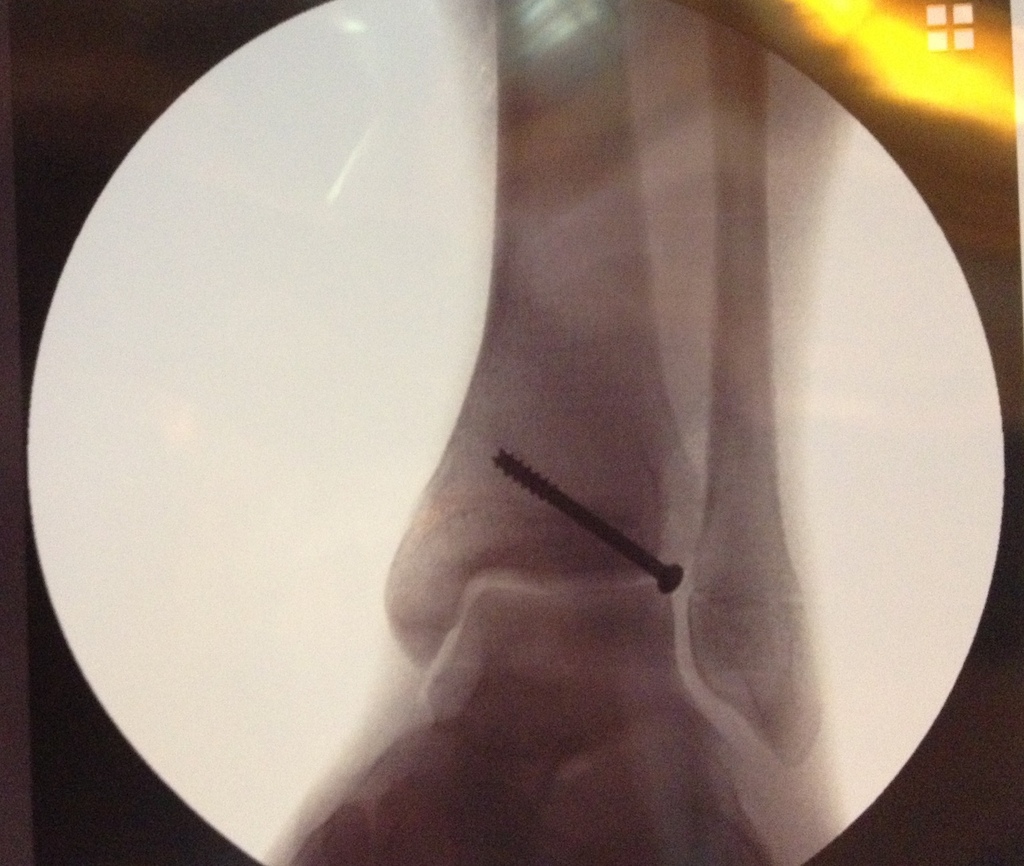 The screw that repaired the tillaux fracture(chip) in my tibia bone.