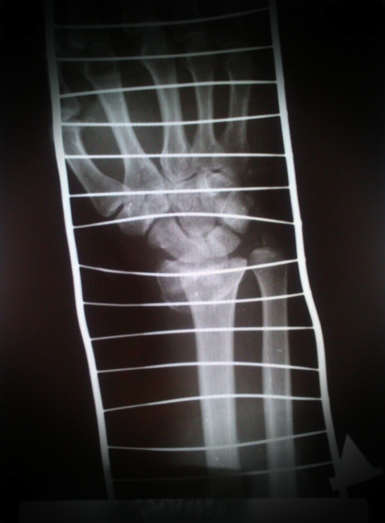 Colles fracture