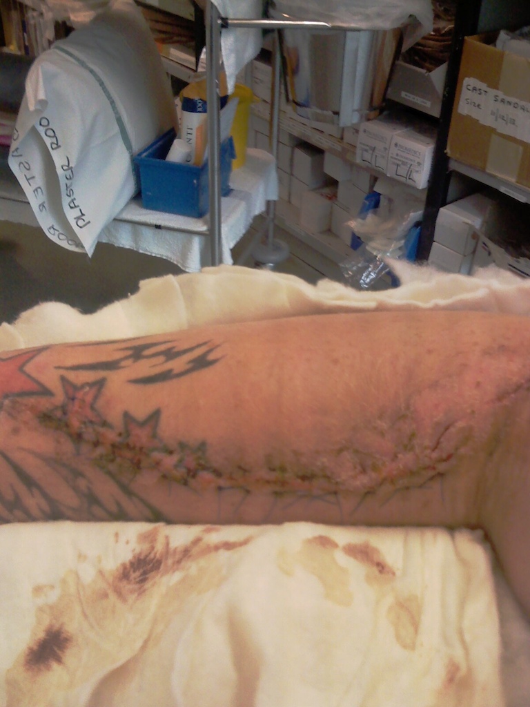 Hit and run by a car , got to see my own bones!