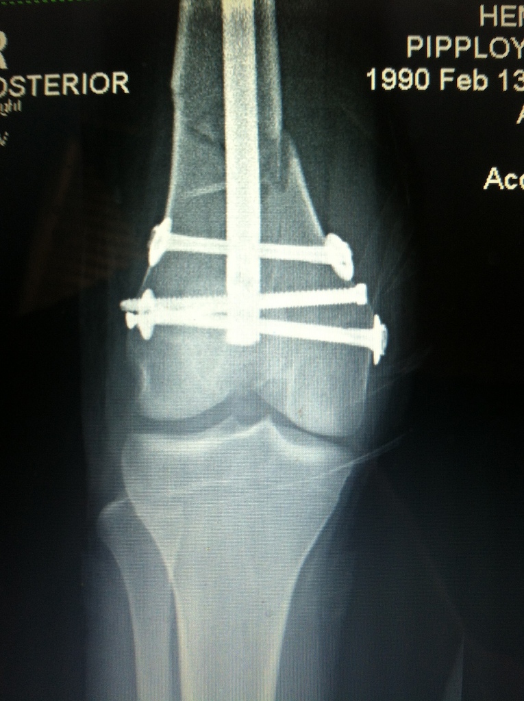 Broken femur got some fancy screws an a rod