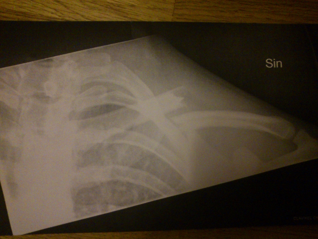 when i finally got back on my bike i went over the bars and broke my collarbone. got 3 months of no riding infront of me =(