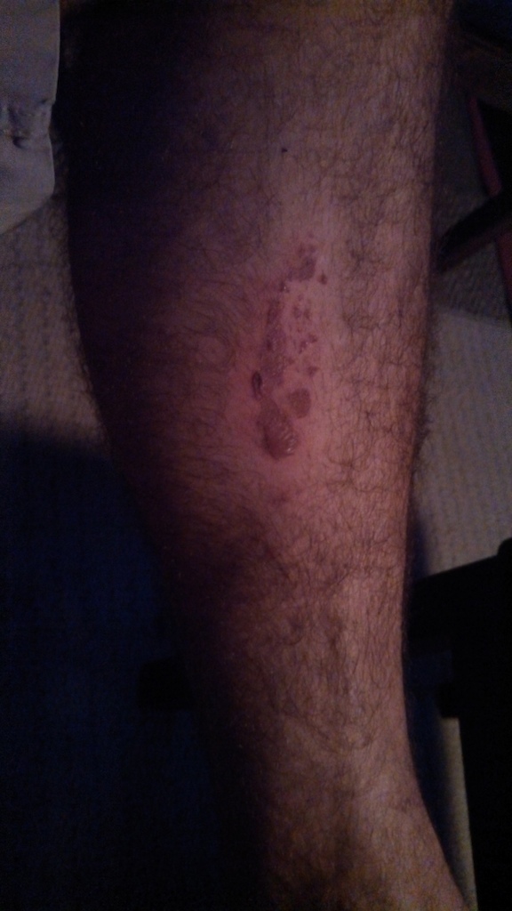 Rotor Burn