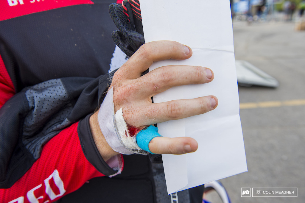 Brendawg wasn't the only one to have a bit of an episode on his final practice run: Gwin's right hand is now sporting a bit of a hole between the outside two knuckles.