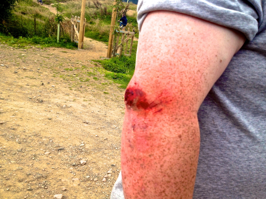 Elbow, no skin...