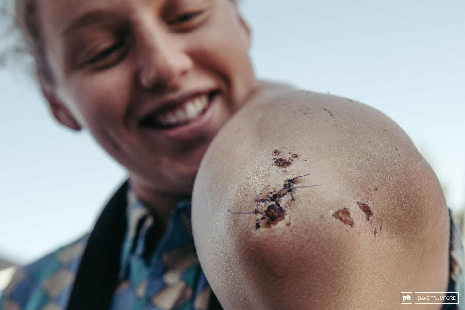 Bex Baraona admiring the first stitches of her lifetime. Unfortunately some cracked ribs will keep her out of the mix this weekend.