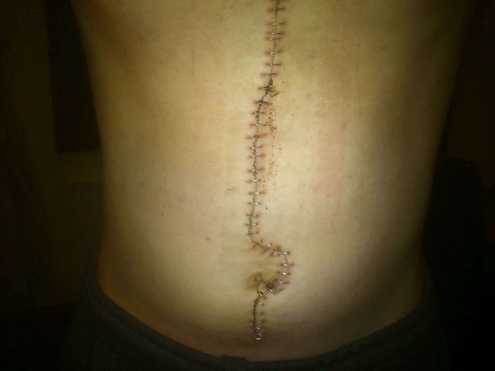 1 week after surgery.
reson for surgery = cancer